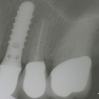 Exemple 4: Un implant au niveau d'une prémolaire supérieure gauche.